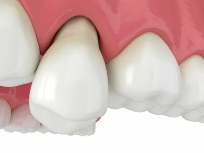 Зуб мудрости: удалять или нет, чем опасны третьи моляры — D.Ante
