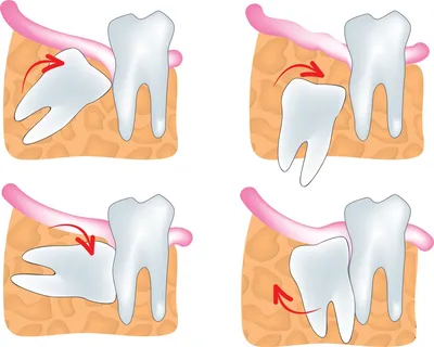 Шатается зуб — что делать, симптомы, методы лечения и укрепления зубов у  взрослых и детей