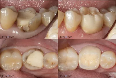 Удаление корня зуба — показания, как происходит процедура, боль при удалении