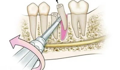 Как определить удалять зуб или можно восстановить | Статья врача стоматолога