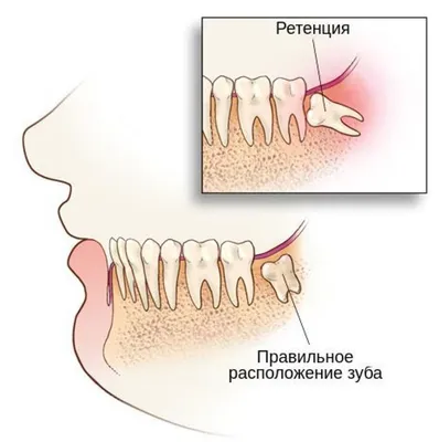 Удаление нерва зуба: как и для чего проводят процедуру — D.Ante