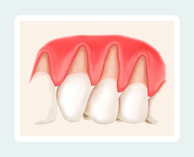 Почему выпадают зубы у взрослых – стоматология Президент