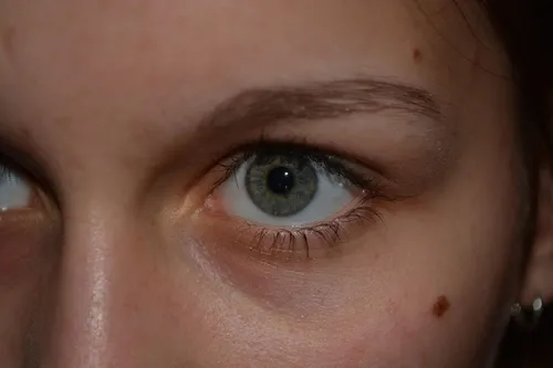 Меланома Фото крупный план глаза человека