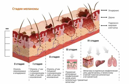 Меланома Фото 4K