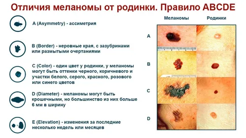 Меланома Фото графический интерфейс пользователя, приложение