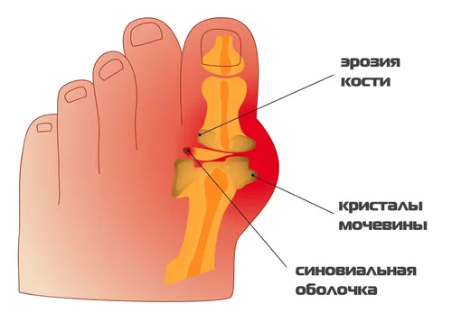 Подагра Фото заставка