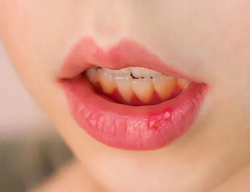 Стоматит Фото крупный план губ человека