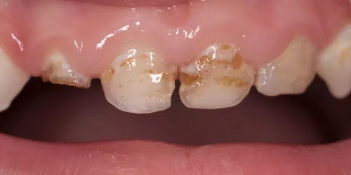 Стоматит Фото крупный план зубов и языка