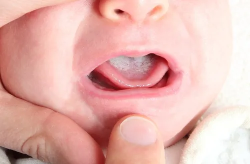 Стоматит Фото крупный план рта ребенка