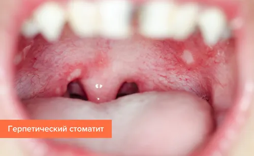 Стоматит Фото крупный план рта человека