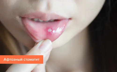 Стоматит Фото крупный план женского рта