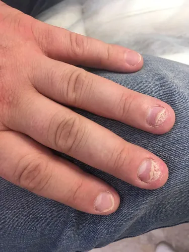 Псориаз Фото рука человека с нарисованными ногтями