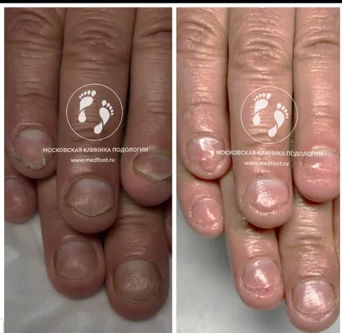 Псориаз Фото крупный план ногтей человека