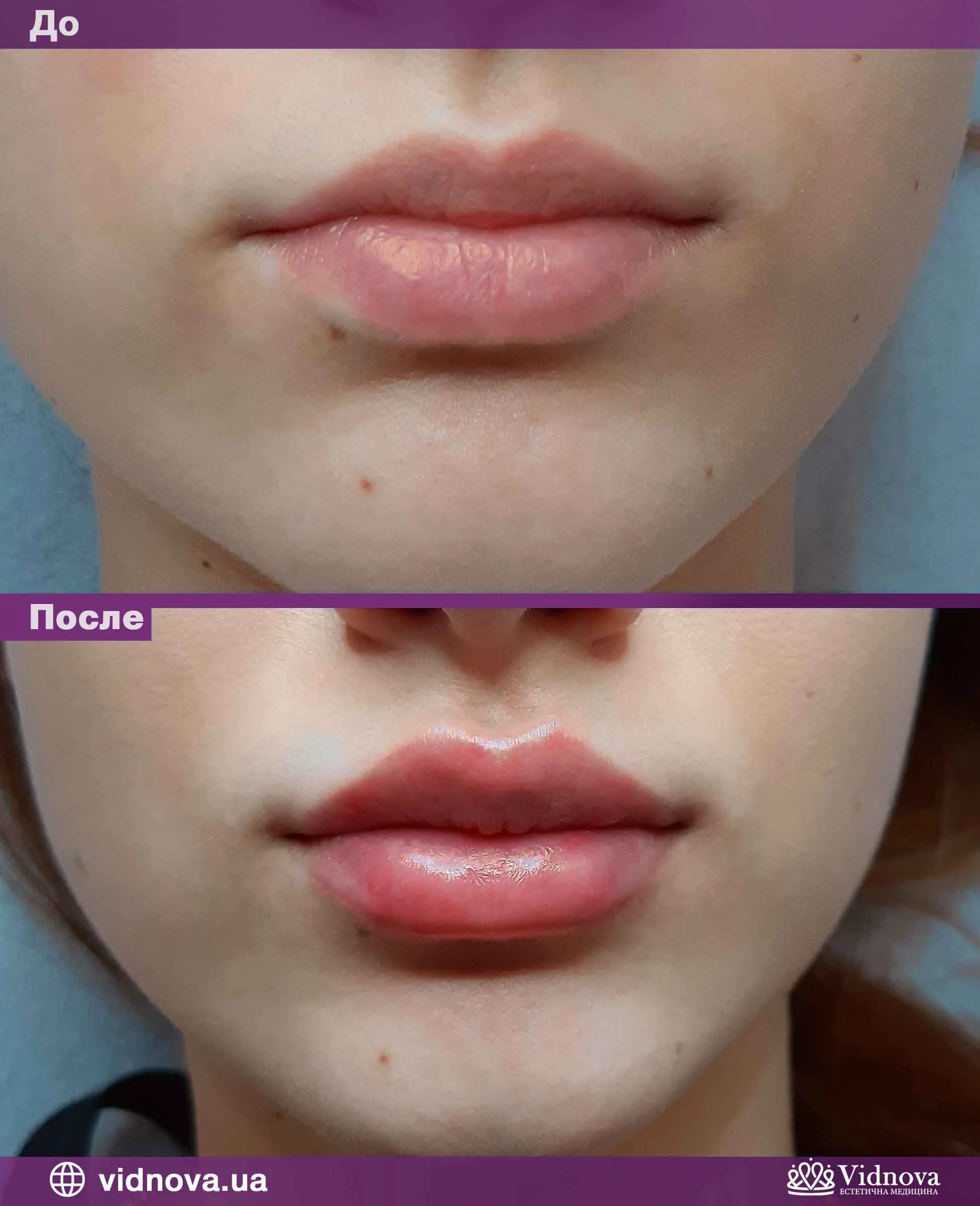 Увеличение губ: гайд года - Coolaser Clinic