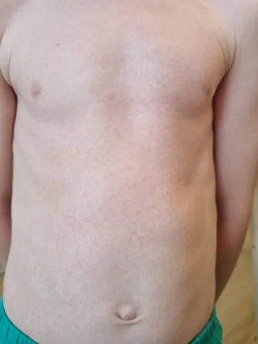 Краснуха Фото грудь человека крупным планом