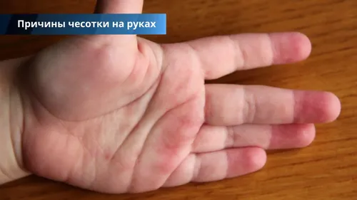 Чесотка Фото крупный план рук человека