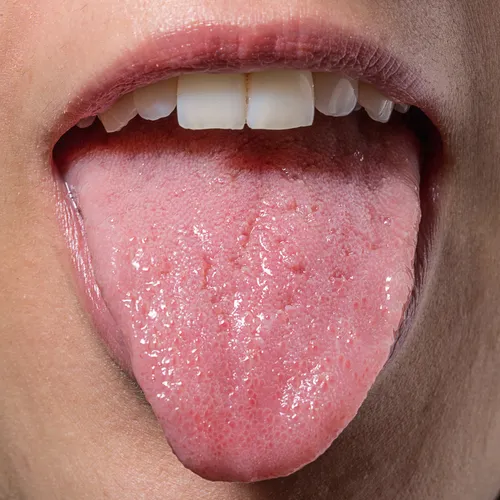 Сыпь При Онкологии Фото крупный план рта человека