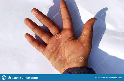 Экзема Фото рука с вытянутым пальцем