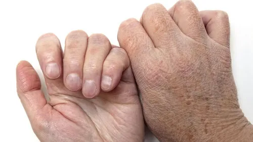 Экзема Фото пара рук, держащих друг друга