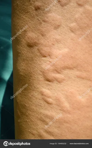 Нервная Крапивница Фото крупный план кожи человека