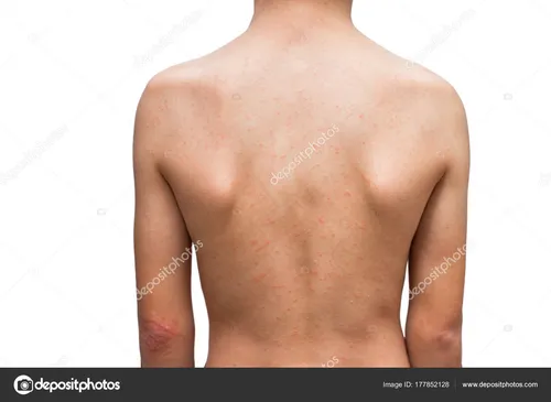 Нервная Крапивница Фото мужская спина без рубашки