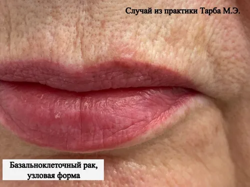 Базалиома Фото закрыть губы человека