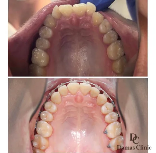 Болезни Малых Губ Фото крупный план зубов человека