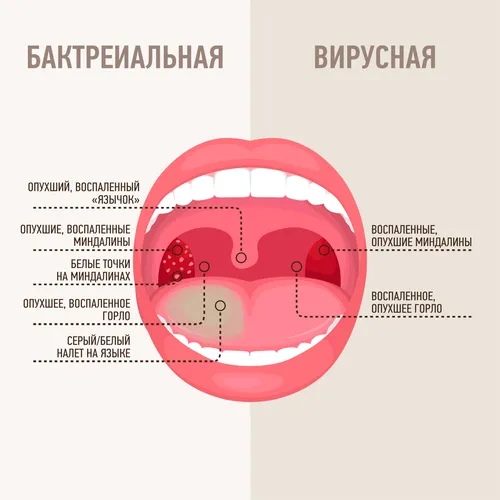 Гнойная Ангина Фото арт