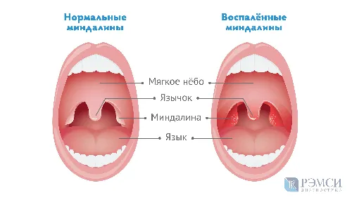 Гнойная Ангина Фото диаграмма