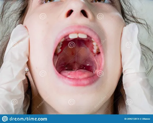 Гнойная Ангина Фото женщина с открытым ртом