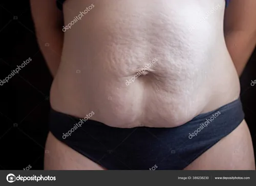 Диастаз Фото грудь женщины крупным планом
