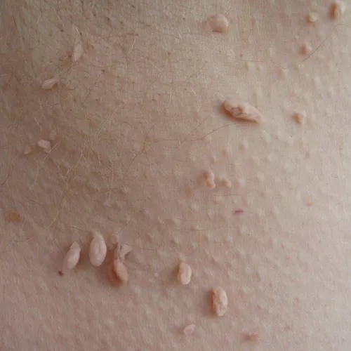 Злокачественные Папилломы Фото крупный план кожи