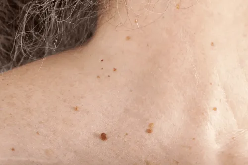 Злокачественные Папилломы Фото крупный план кожи человека