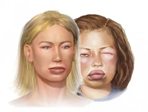 Лицо При Гипотиреозе Фото человек с закрытыми глазами и открытым ртом рядом с другой женщиной