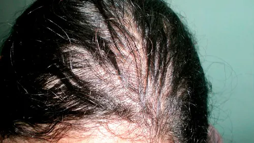 Лицо При Гипотиреозе Фото крупный план волос человека