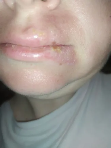 Опоясывающий Лишай Фото крупный план губ человека