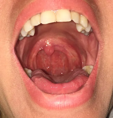 Фарингит Фото рот человека открыт с показом зубов