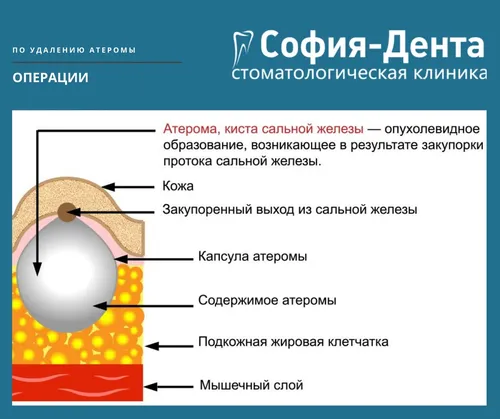 Атерома Фото  скачать фото