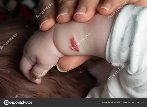 Гемангиома Фото крупный план ножек ребенка