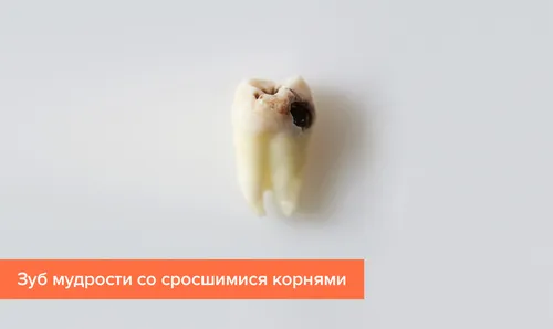 Зуб Мудрости Фото маленький белый предмет