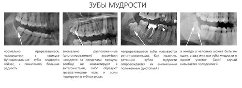 Зуб Мудрости Фото диаграмма