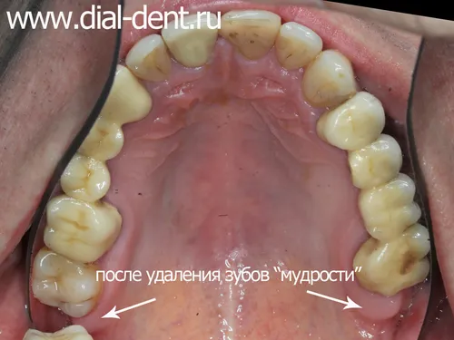 Зуб Мудрости Фото крупный план рта человека