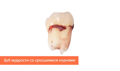 Зуб Мудрости Фото крупный план человеческого черепа