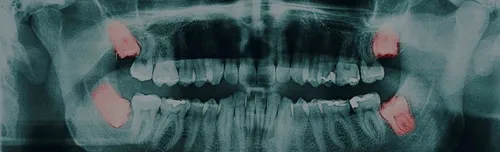Зуб Мудрости Фото лицо человека крупным планом