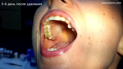 Зуб Мудрости Фото крупный план рта человека с сыпью на нем