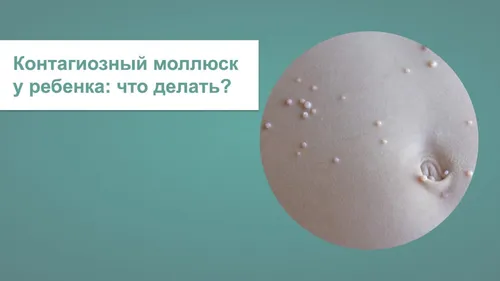 Контагиозный Моллюск Фото круглый объект с текстом над ним