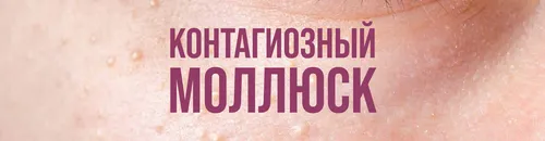 Контагиозный Моллюск Фото розово-фиолетовый знак
