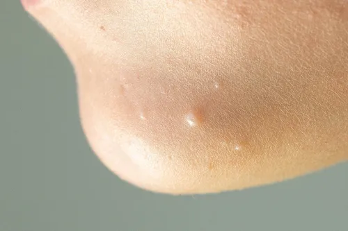 Контагиозный Моллюск Фото крупный план кожи человека