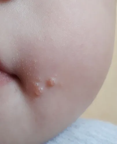 Контагиозный Моллюск Фото крупный план рта человека