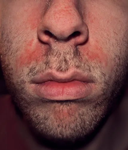 Красные Пятна На Коже И Названия Фото мужское лицо с усами